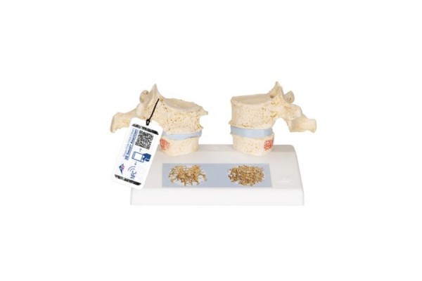 model dydaktyczny osteoporozy - 3b smart anatomy - 1000182 [a95] 3b scientific modele anatomiczne 2